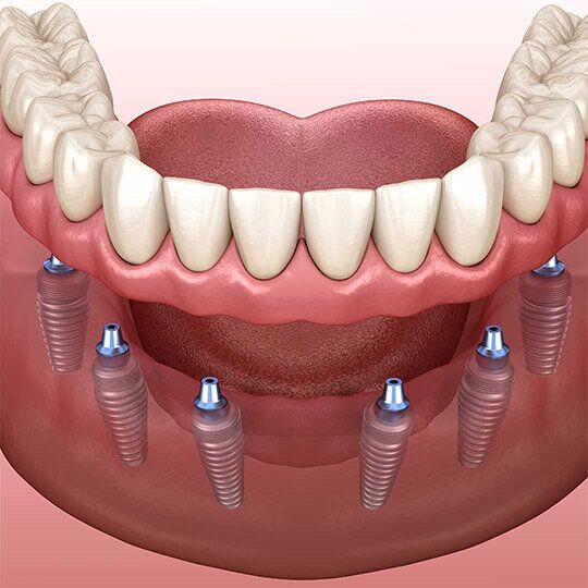 All on 6 Dental Implants in Dubai - Micris Dental Clinic